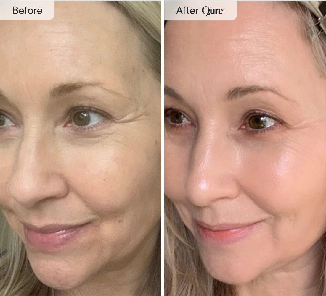 Q-Rejuvalight Pro LED Face Mask