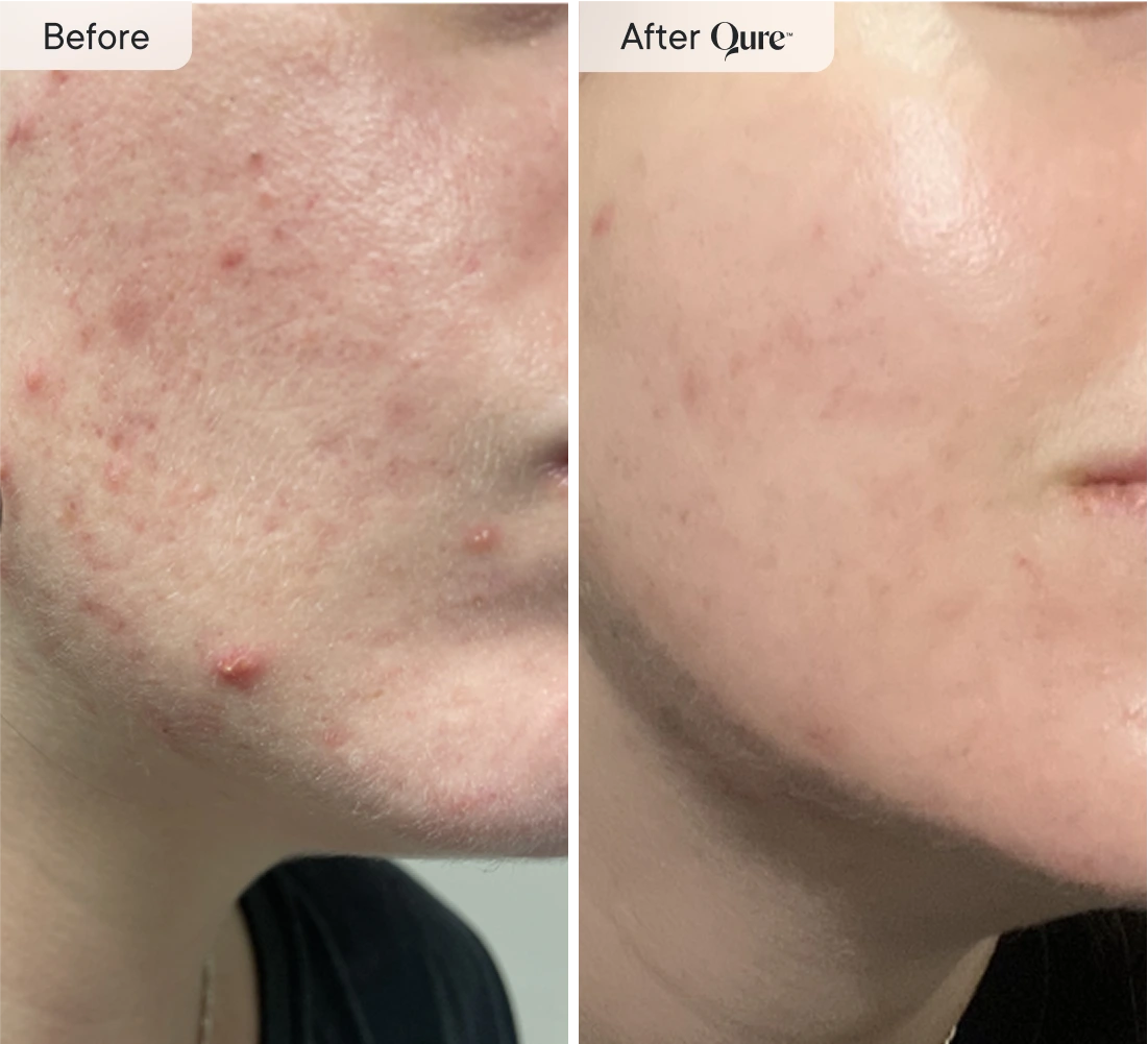 Q-Rejuvalight Pro LED Face Mask