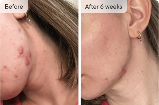 Saw a difference within 3 days!