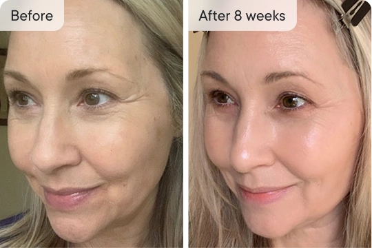 No breakouts for 8 weeks!