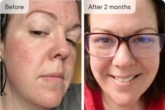 Renewed skin!