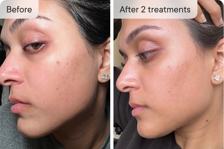 Fade after just two treatments